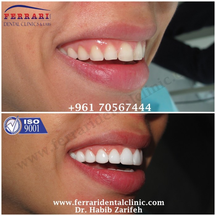 Hollywood-smile-Ferrari-dental-clinic-Lebanon