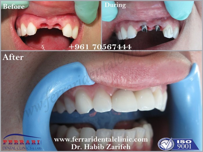 1-Dental-Implants-Lebanon-Habib-Zarifeh