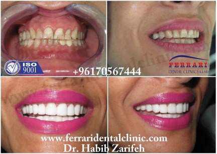 Hollywood-smile-with-Dr. Habib-Zarifeh