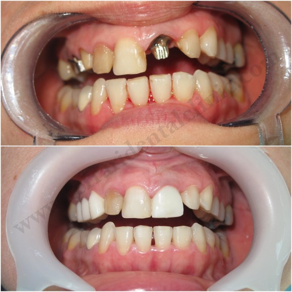Zirconium Crownsby Dr. Habib Zarifeh